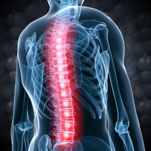 Rückenmarkstumoren Wirbelsäule