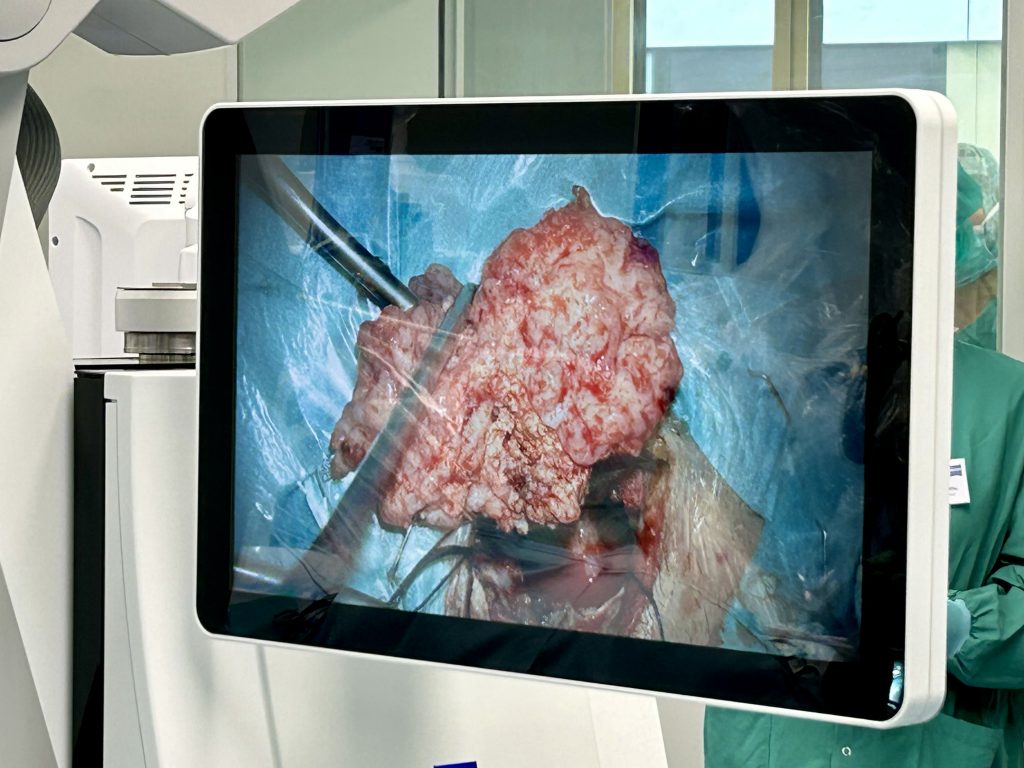 Hirntumor-OP, Burgenland, Prof. Feigl, minimalinvasiv, Neurochirurgie