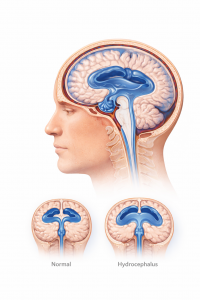 Hydrozephalus erklärt