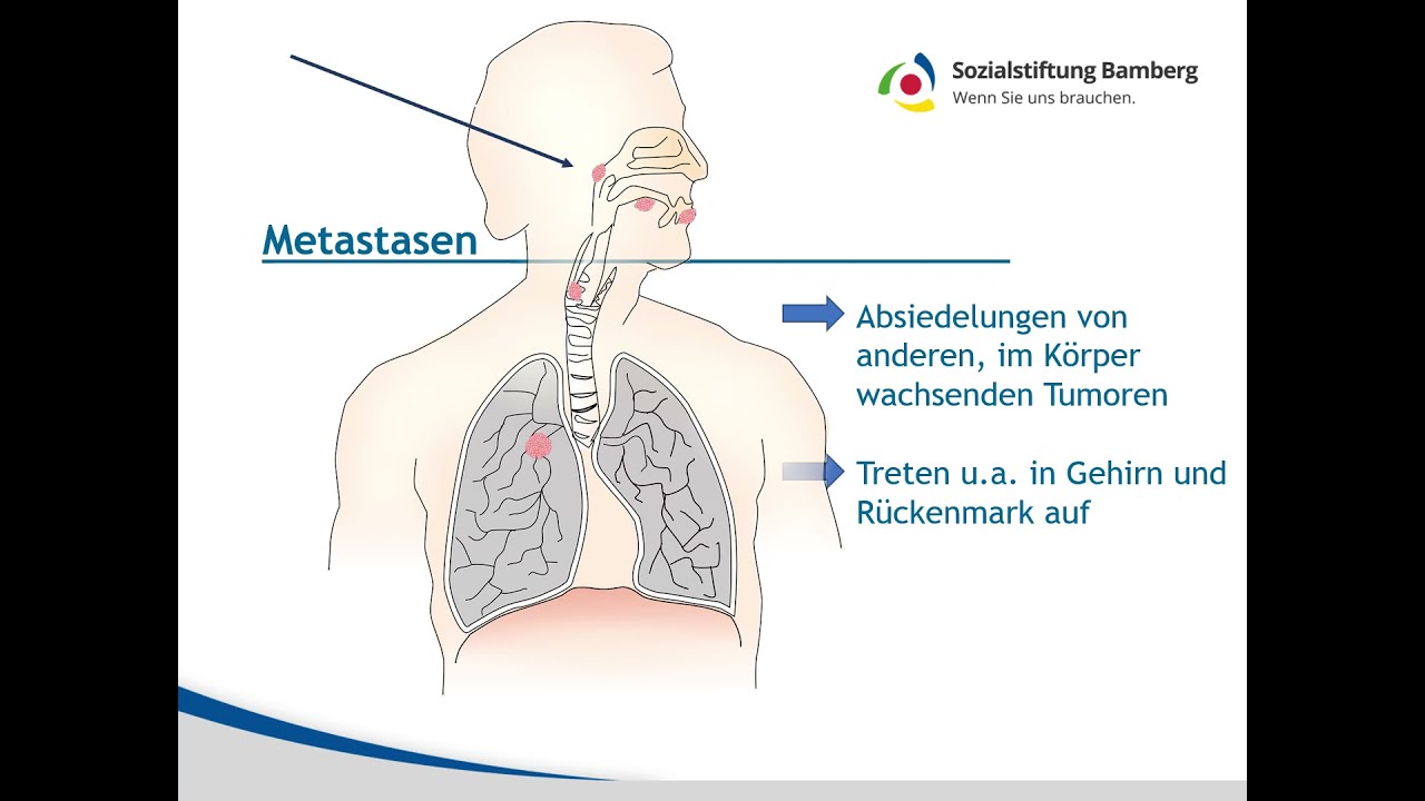 Wie Werden Metastasen In Der Lunge Behandelt hirntumor-zentrum.de